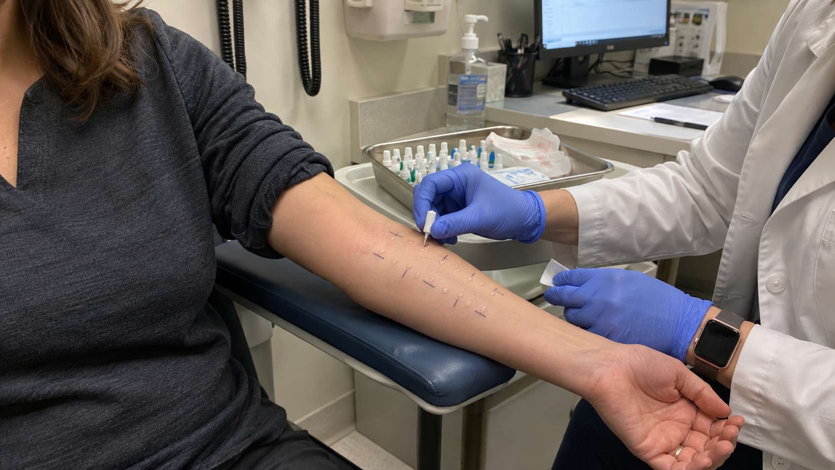 Patient receiving skin prick allergy testing on the forearm in an allergy clinic.